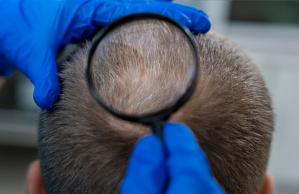 Tratamento para Alopecia
